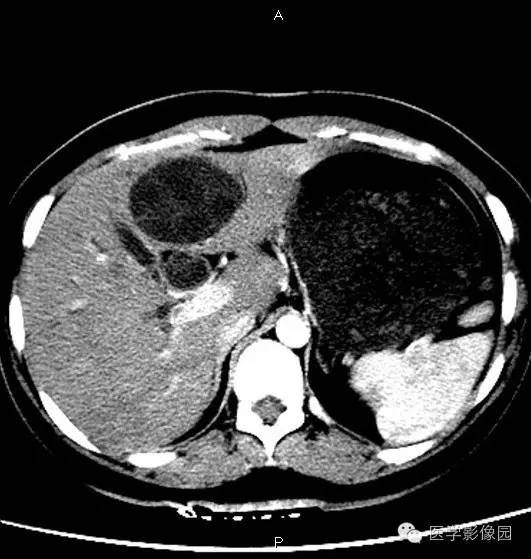 【病例】肝脏囊腺瘤1例CT影像表现 【病例】肝脏囊腺瘤1例CT影像表现