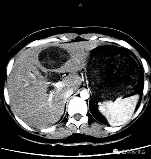 【病例】肝脏囊腺瘤1例CT影像表现 【病例】肝脏囊腺瘤1例CT影像表现