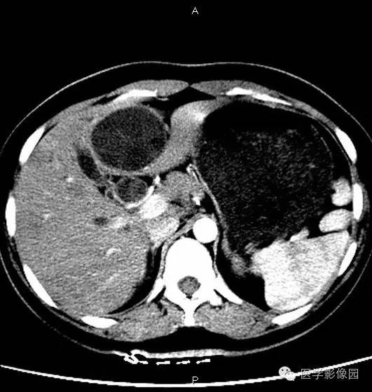 【病例】肝脏囊腺瘤1例CT影像表现 【病例】肝脏囊腺瘤1例CT影像表现