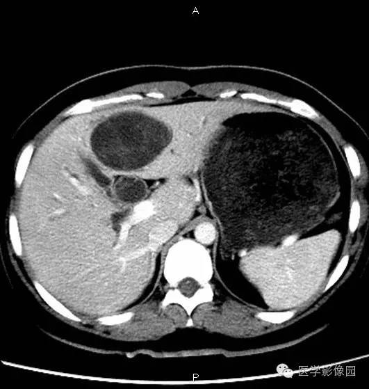 【病例】肝脏囊腺瘤1例CT影像表现 【病例】肝脏囊腺瘤1例CT影像表现