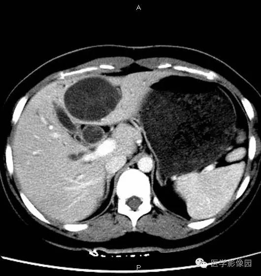 【病例】肝脏囊腺瘤1例CT影像表现 【病例】肝脏囊腺瘤1例CT影像表现