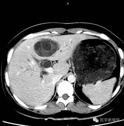 【病例】肝脏囊腺瘤1例CT影像表现 【病例】肝脏囊腺瘤1例CT影像表现