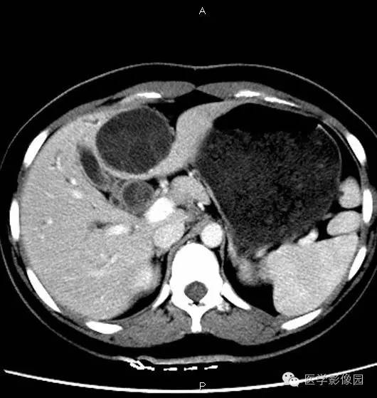【病例】肝脏囊腺瘤1例CT影像表现 【病例】肝脏囊腺瘤1例CT影像表现