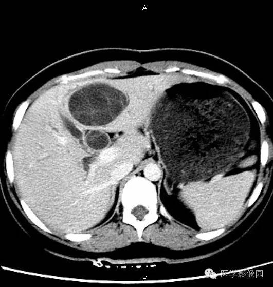 【病例】肝脏囊腺瘤1例CT影像表现 【病例】肝脏囊腺瘤1例CT影像表现
