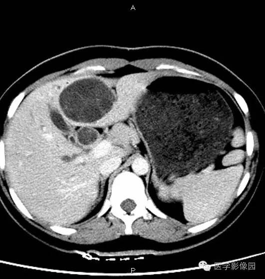 【病例】肝脏囊腺瘤1例CT影像表现 【病例】肝脏囊腺瘤1例CT影像表现