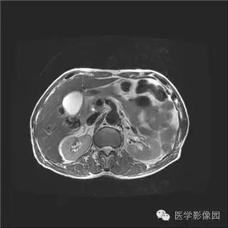 【病例】胰岛细胞瘤1例MR影像表现