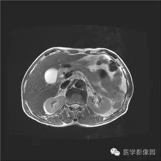 【病例】胰岛细胞瘤1例MR影像表现