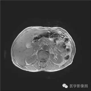 【病例】胰岛细胞瘤1例MR影像表现