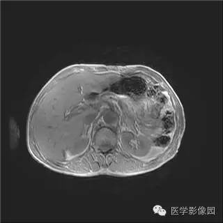 【病例】胰岛细胞瘤1例MR影像表现