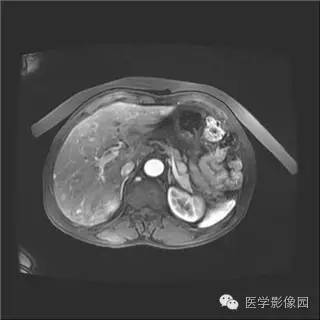 【病例】胰岛细胞瘤1例MR影像表现