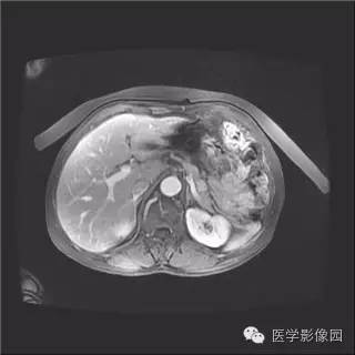【病例】胰岛细胞瘤1例MR影像表现