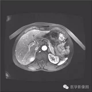 【病例】胰岛细胞瘤1例MR影像表现