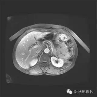 【病例】胰岛细胞瘤1例MR影像表现