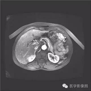 【病例】胰岛细胞瘤1例MR影像表现