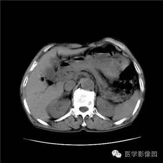 【病例】胰岛细胞瘤1例MR影像表现