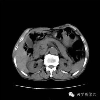 【病例】胰岛细胞瘤1例MR影像表现