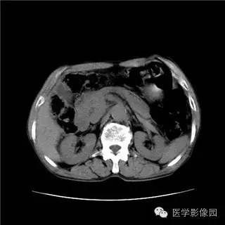 【病例】胰岛细胞瘤1例MR影像表现