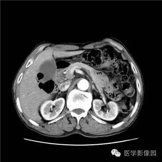 【病例】胰岛细胞瘤1例MR影像表现