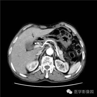 【病例】胰岛细胞瘤1例MR影像表现