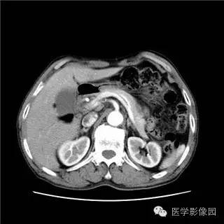 【病例】胰岛细胞瘤1例MR影像表现