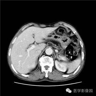 【病例】胰岛细胞瘤1例MR影像表现