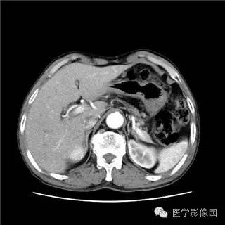 【病例】胰岛细胞瘤1例MR影像表现