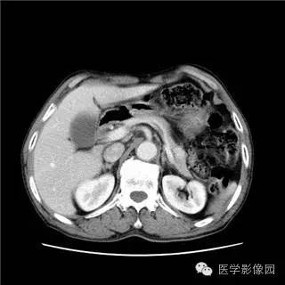 【病例】胰岛细胞瘤1例MR影像表现