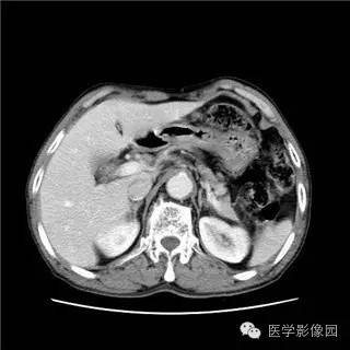 【病例】胰岛细胞瘤1例MR影像表现