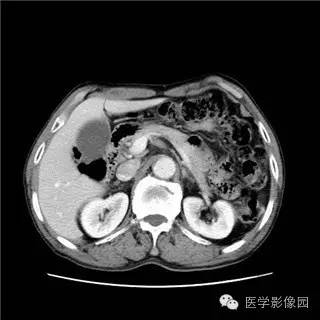 【病例】胰岛细胞瘤1例MR影像表现