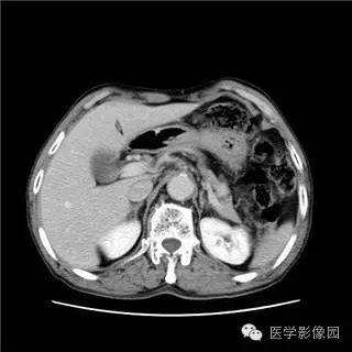 【病例】胰岛细胞瘤1例MR影像表现