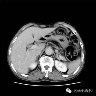 【病例】胰岛细胞瘤1例MR影像表现