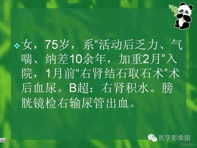 【病例】肾盂癌1例CT影像表现 【病例】肾盂癌1例CT影像表现