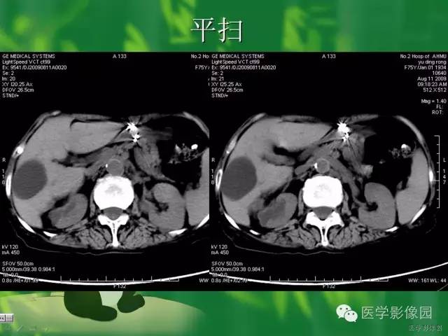 【病例】肾盂癌1例CT影像表现 【病例】肾盂癌1例CT影像表现