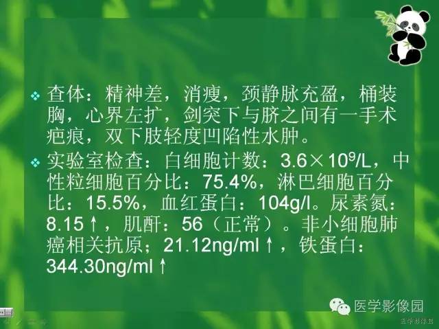 【病例】肾盂癌1例CT影像表现 【病例】肾盂癌1例CT影像表现