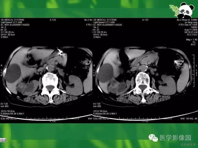 【病例】肾盂癌1例CT影像表现 【病例】肾盂癌1例CT影像表现