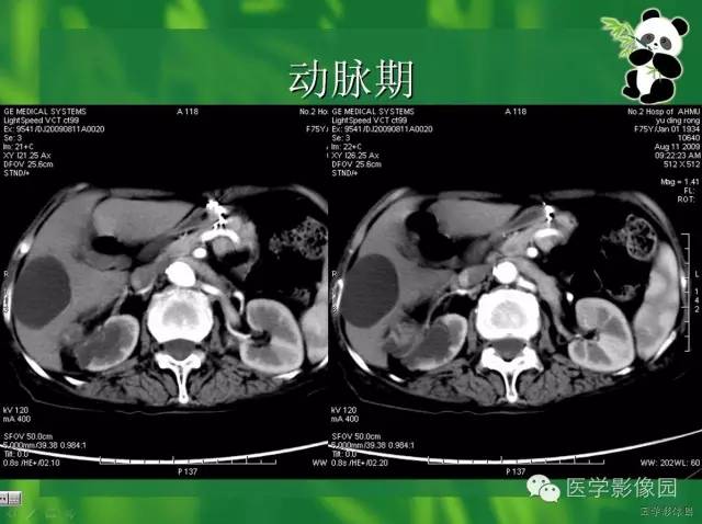 【病例】肾盂癌1例CT影像表现 【病例】肾盂癌1例CT影像表现