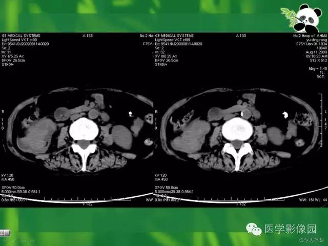 【病例】肾盂癌1例CT影像表现 【病例】肾盂癌1例CT影像表现