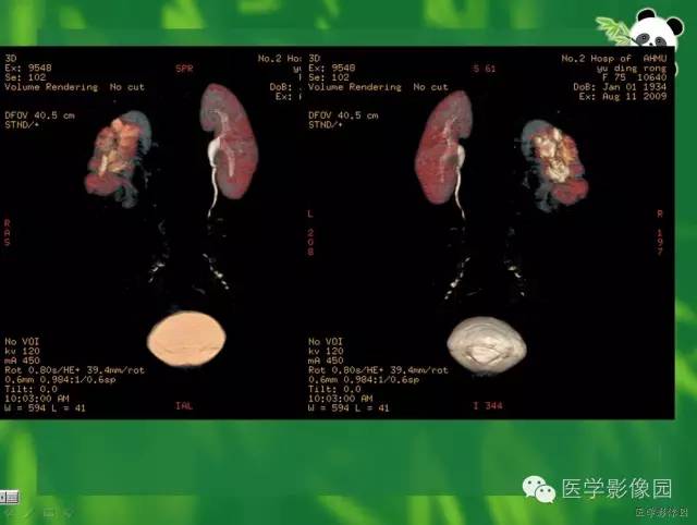 【病例】肾盂癌1例CT影像表现 【病例】肾盂癌1例CT影像表现