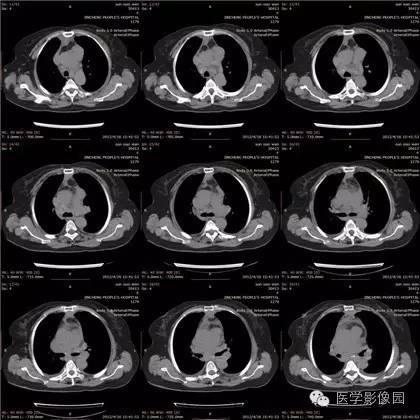 【病例】纵隔淋巴瘤1例CT影像表现 【病例】纵隔淋巴瘤1例CT影像表现