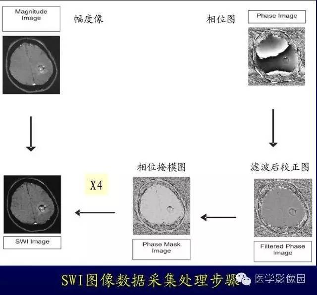 【PPT】MR磁敏感成像SWI原理及其在脑部的应用