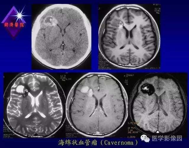 【PPT】MR磁敏感成像SWI原理及其在脑部的应用