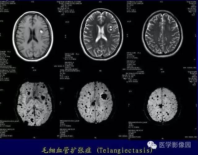 【PPT】MR磁敏感成像SWI原理及其在脑部的应用