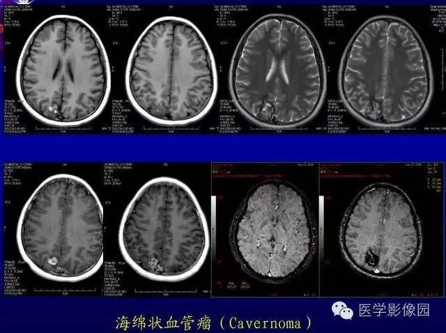 【PPT】MR磁敏感成像SWI原理及其在脑部的应用