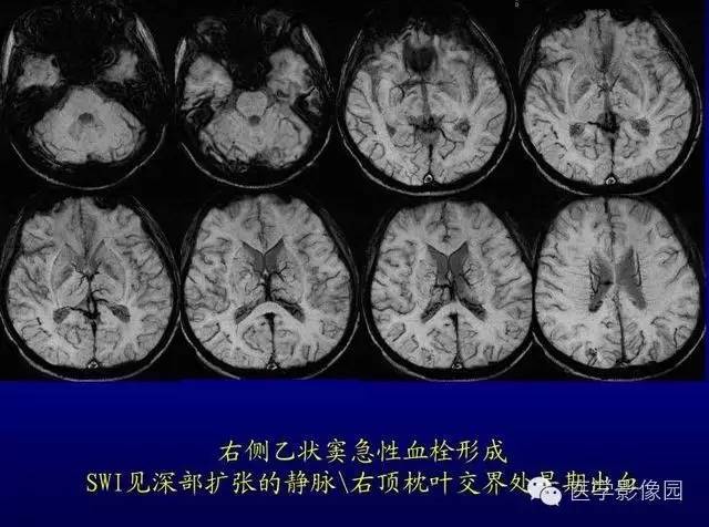 【PPT】MR磁敏感成像SWI原理及其在脑部的应用
