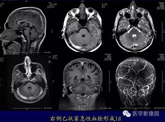 【PPT】MR磁敏感成像SWI原理及其在脑部的应用