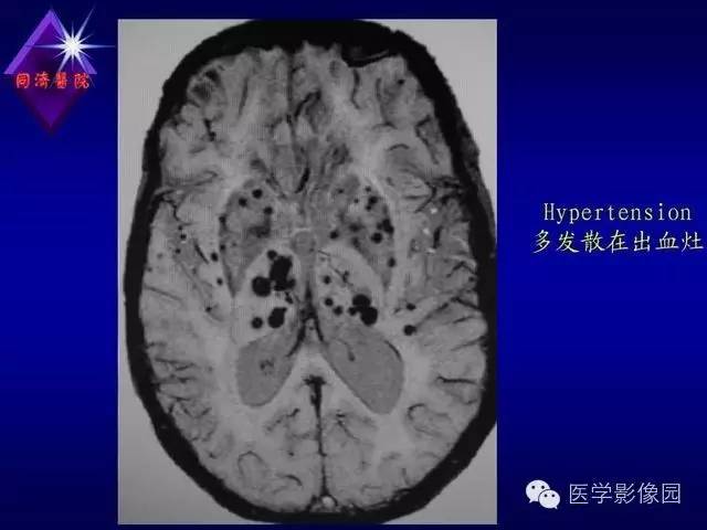 【PPT】MR磁敏感成像SWI原理及其在脑部的应用