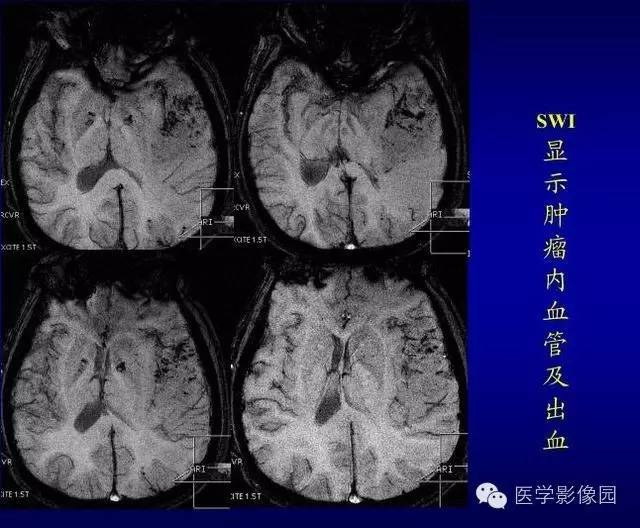 【PPT】MR磁敏感成像SWI原理及其在脑部的应用