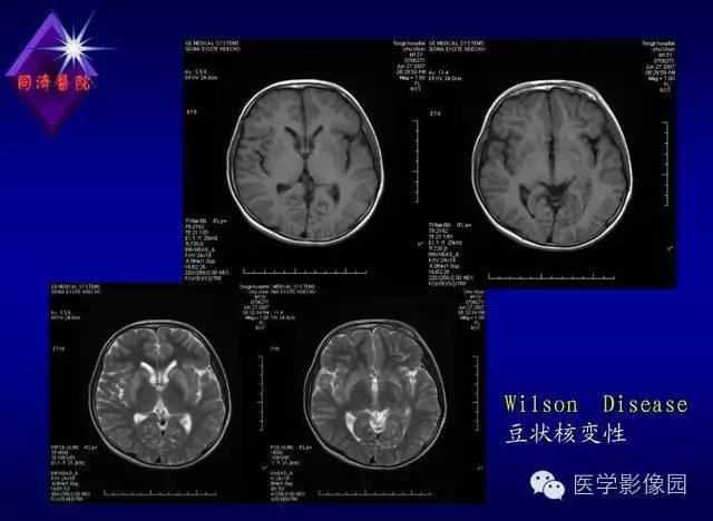 【PPT】MR磁敏感成像SWI原理及其在脑部的应用