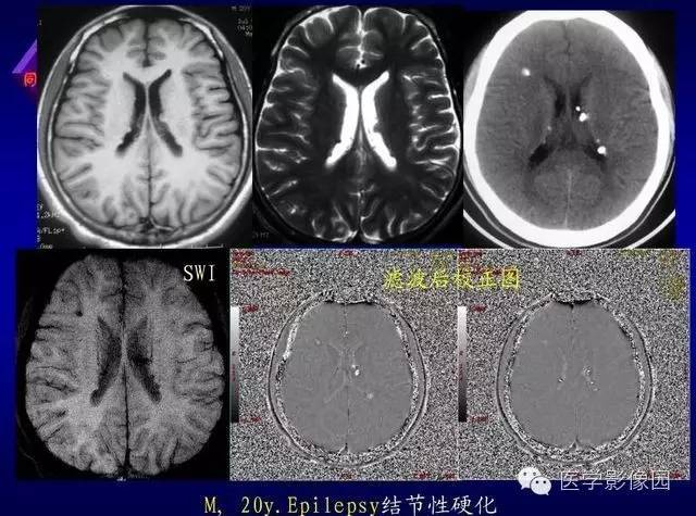 【PPT】MR磁敏感成像SWI原理及其在脑部的应用