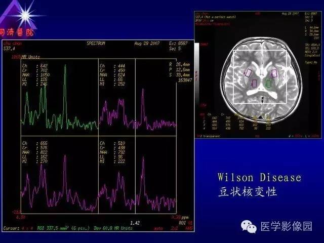 【PPT】MR磁敏感成像SWI原理及其在脑部的应用